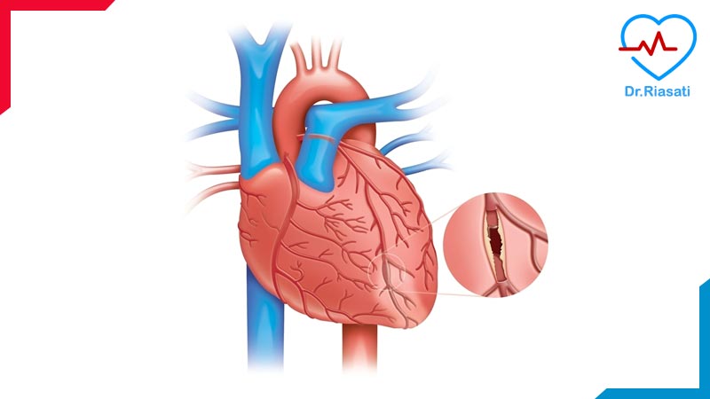 آنژیوگرافی قلب