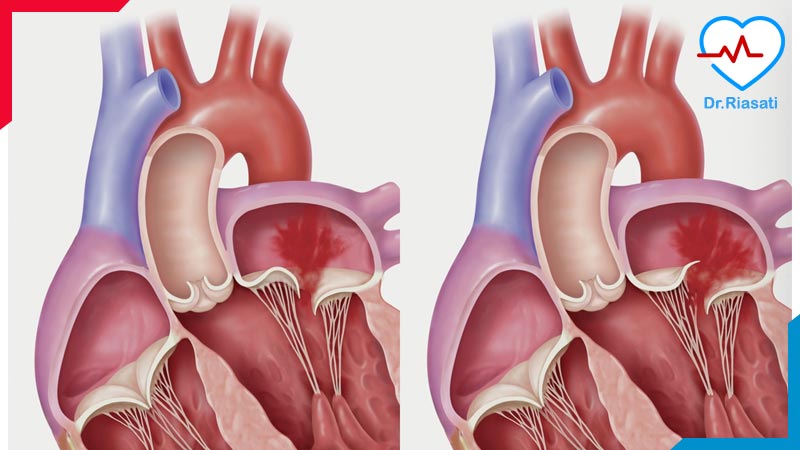 افتادگی دریچه میترال