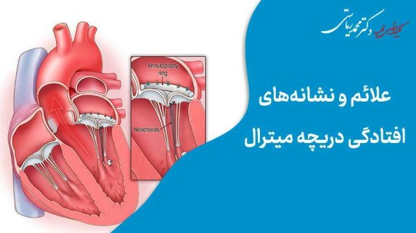 علائم و نشانه های افتادگی دریچه میترال