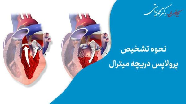 نحوه تشخیص پرولاپس دریچه‌ میترال