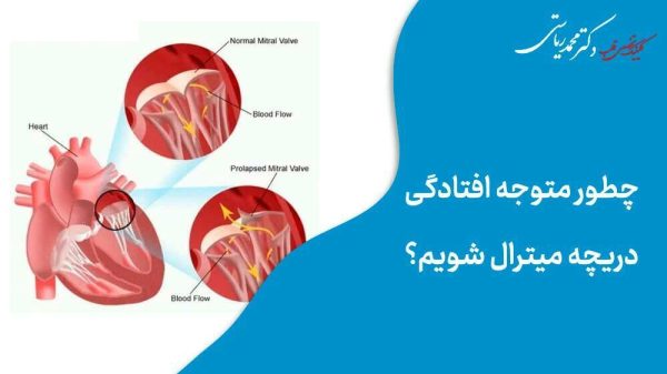 چطور متوجه افتادگی دریچه میترال شویم؟