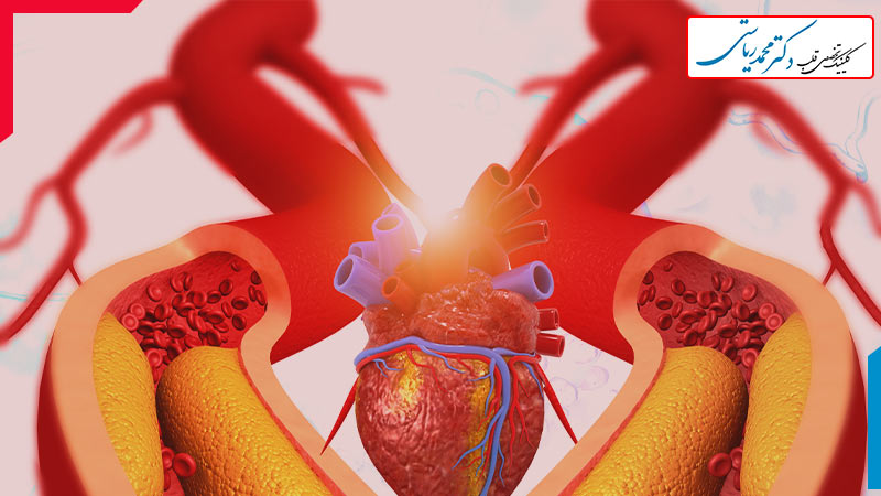 گرفتگی رگ قلب گرفتگی رگ قلب