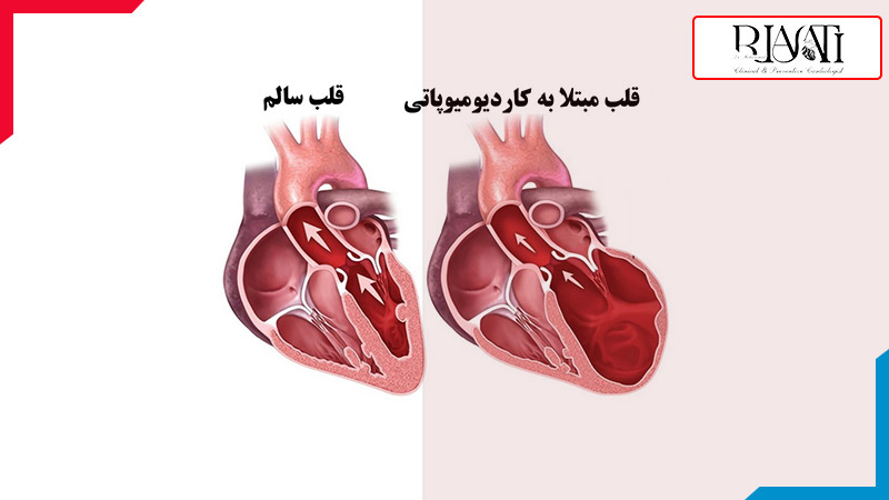 قلب فرد مبتلا به کاردیومیوپاتی و قلب فرد سالم قلب فرد مبتلا به کاردیومیوپاتی و قلب فرد سالم