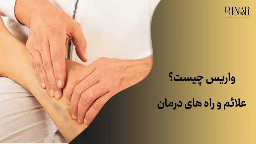بیماری واریس چیست؟