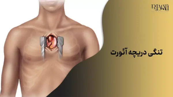 تنگی دریچه آئورت