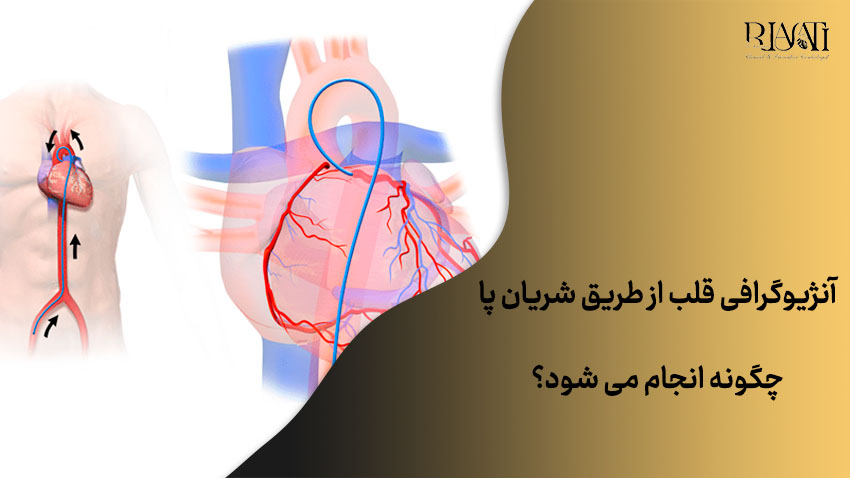 آنژیوگرافی قلب از طریق شریان پا 1